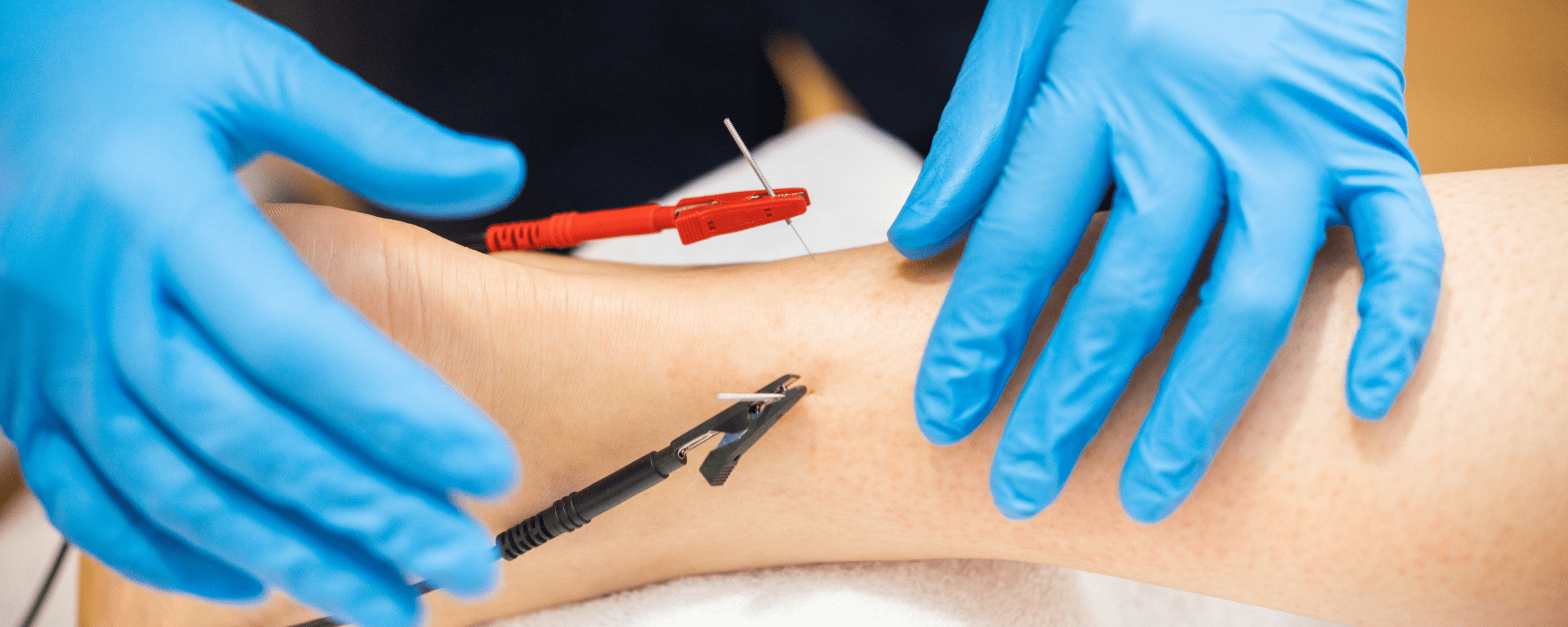 Electro Neuro Acupuntura (ENA)