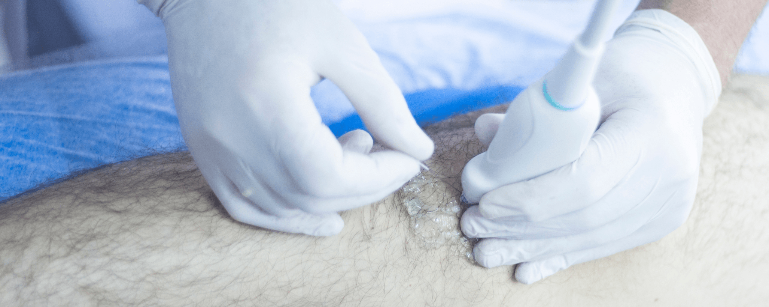 Neuromodulación Percutánea (NPE)