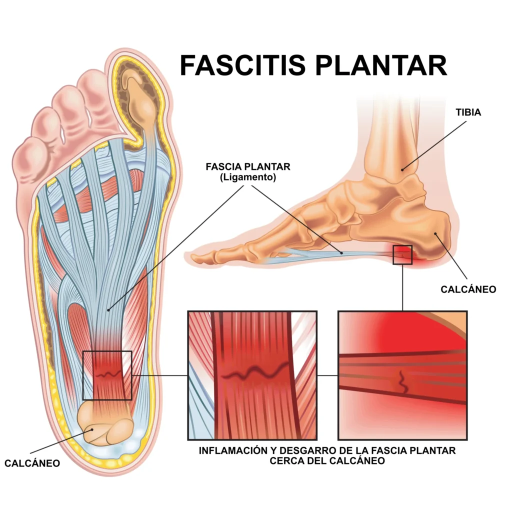 FASCITIS PLANTAR